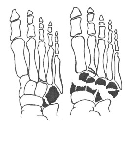 Кости предплюсны Перелом костей предплюсны