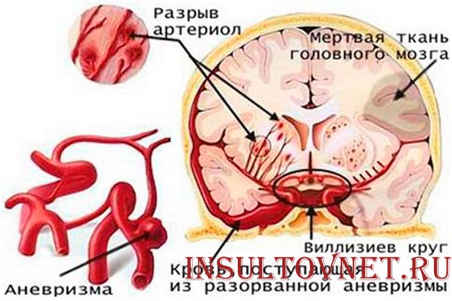 САК при инсульте