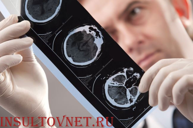 Стадии инсульта