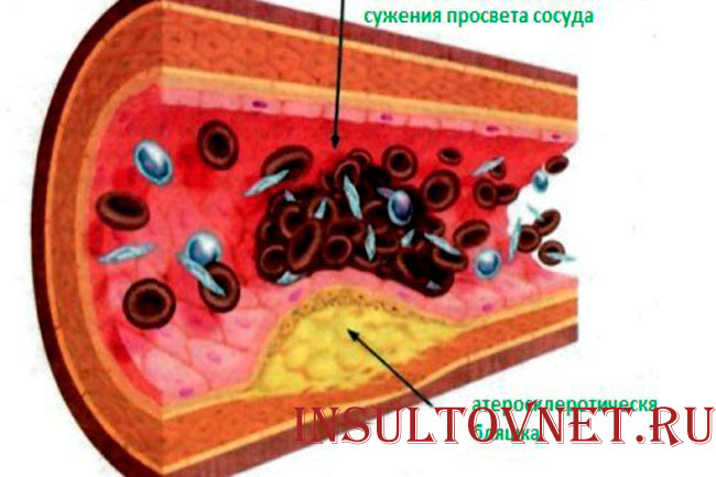 Атеросклероз сосудов головного мозга