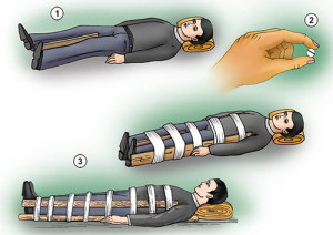 Доврачебная помощь при переломе бедра Переломы бедра практически всегда сопровождаются кровопотерей