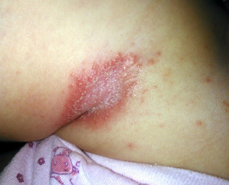 грибок на коже