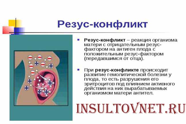 Резус-конфликт при беременности