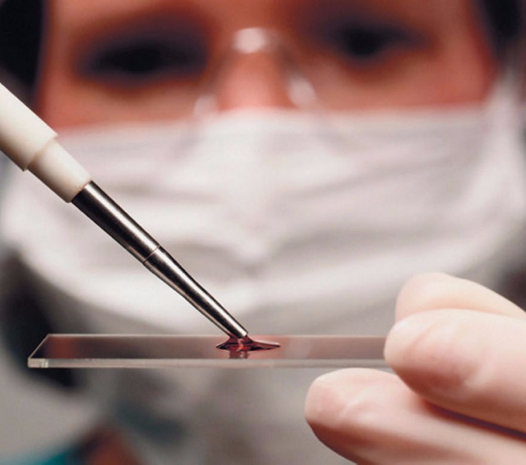 Анализ крови на токсокароз