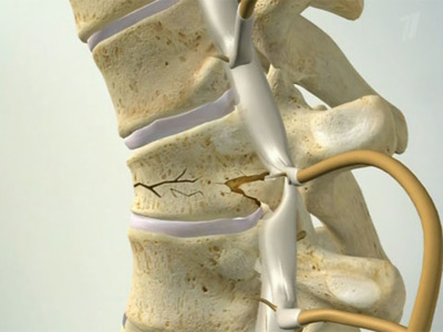 сломанная спина Перелом позвоночника считается тяжелым повреждением