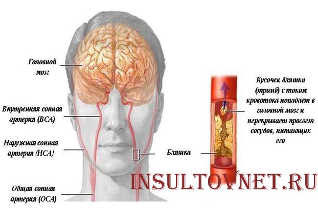 Атеросклероз сонных артерий