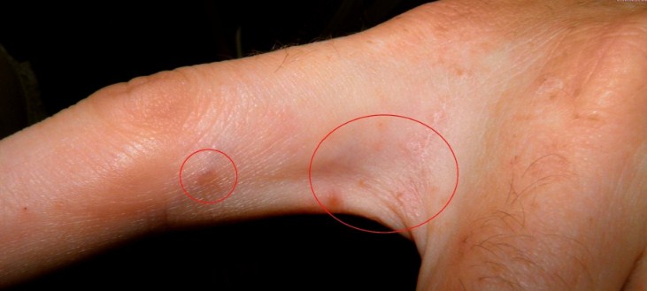 поражение кожи