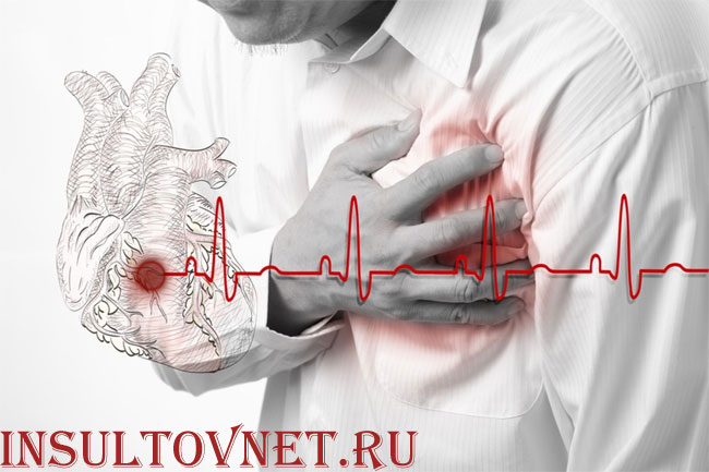 инфаркт