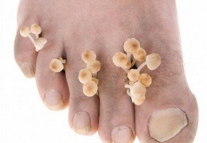 Грибок на ноге симптомы