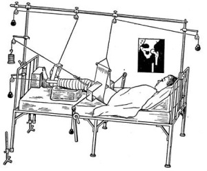 Скелетное вытяжение Скелетное вытяжение бедра