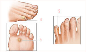 Как выглядит натоптыш на ноге