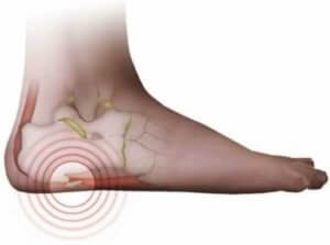 Лечение пяточной шпоры у детей