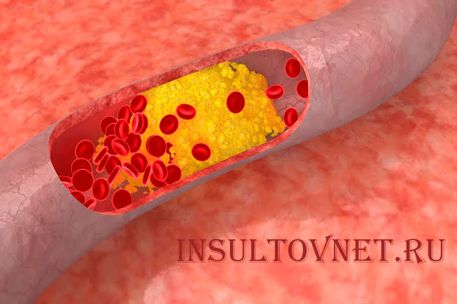 Холестерин в крови