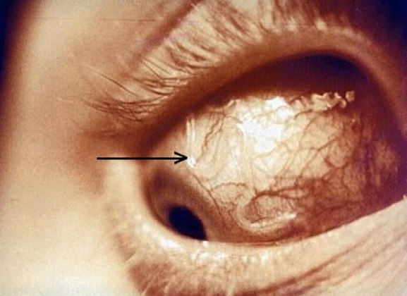 нити глистов в глазу