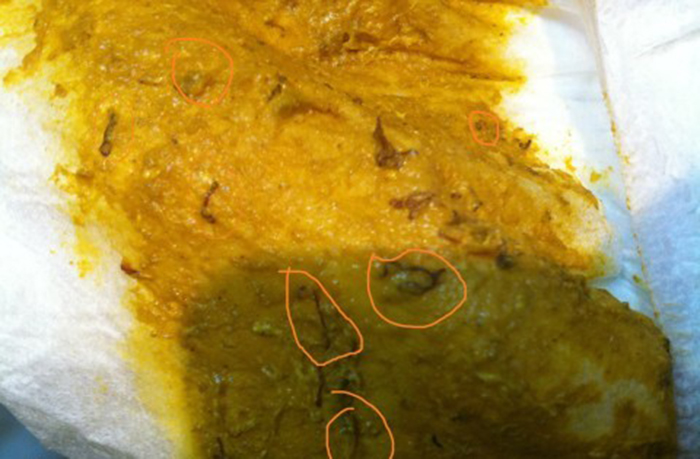 глисты вышли с калом