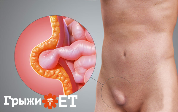 на картинке паховая грыжа