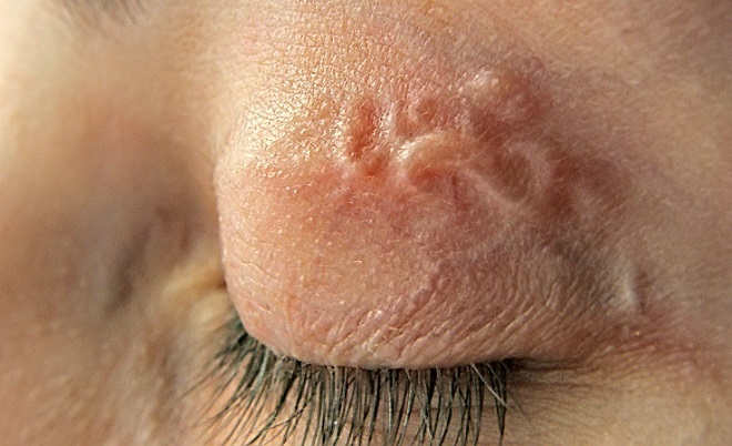 Форма глазного токсокароза