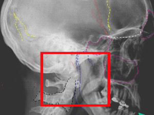 Рентген черепа Перелом основания черепа