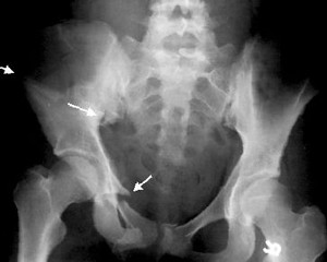 Рентген Перелом таза