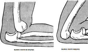 Вывих локтевого сустава Вывих локтевого сустава