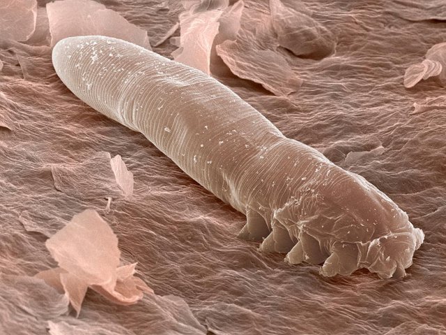 клещ демодекоз