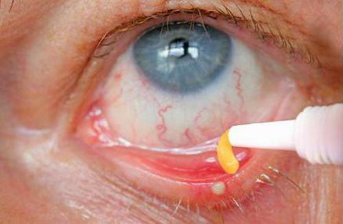 Желто-ртутная глазная мазь: свойства, лечение глаз