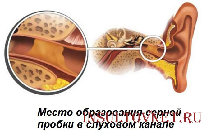 Серная пробка в ухе