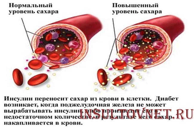 Избыток сахара в крови