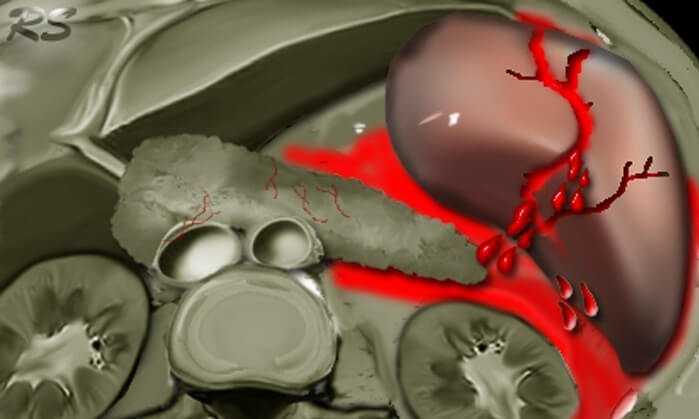 Разрыв селезенки