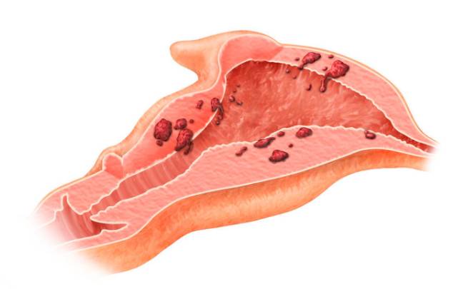 эндометрит