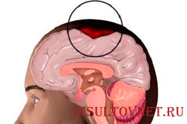 Субарахноидальное кровоизлияние