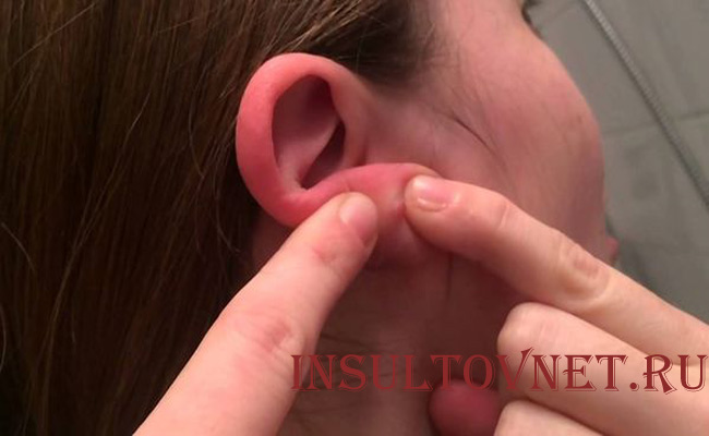 Липома ушной раковины