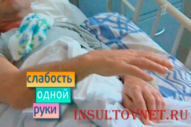Парализация руки