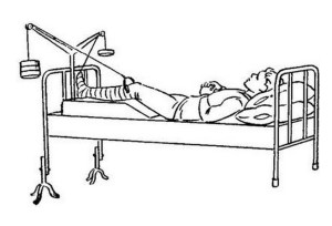 Лечение перелома Вытяжение при переломе