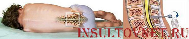 люмбальная пункция