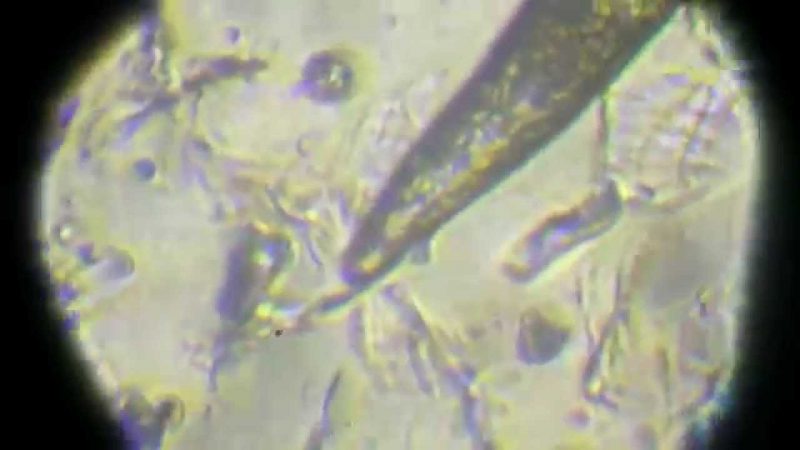 (Подкожный клещ) демодекоз Демодекоз (Подкожный клещ)