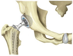 Эндопротезирование бедренной шейки Эндопротезирование - операция в ходе которой разрушенные части заменяются искусственными