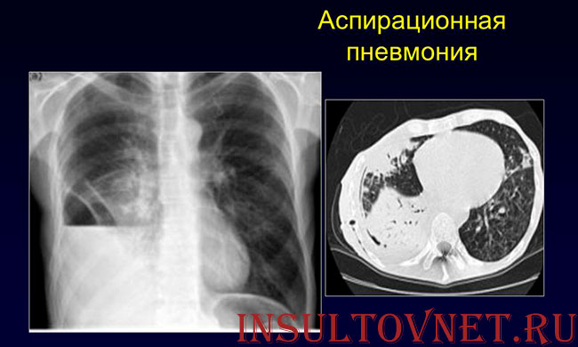 аспирационная пневмония