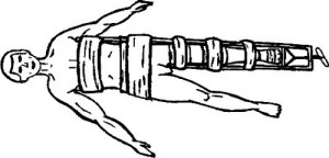 Первая помощь Наложение шины при переломе бедра