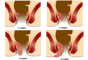 Симптомы геморроя и его стадии