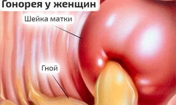 гонорея у женщин