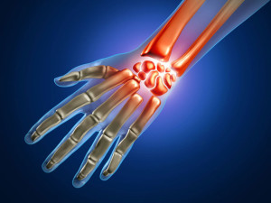 Боль в запястье Болезнь Кинбека