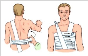 Бинтование ребер Наложение повязки при пневмотораксе