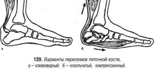 Перелом пятки Несколько степеней тяжести повреждения кости