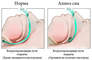 В каких случая применяют пластырь Доктор Храп