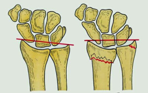 Кости запястья Шиловидный отросток лучевой кости