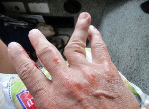 Вывих безымянного пальца руки Вывих пальца