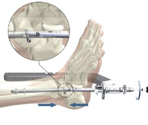 Артродез голеностопа Операция делает сустав неподвижным