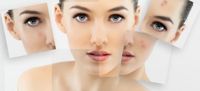 Могут ли быть прыщи от глистов