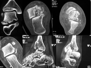 Диагностика кости Выявление некроза на раних стадиях